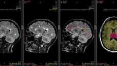 Automatic MRI scan analysis report generated by SNAC's AI-based platform iQ-solutions Automatic MRI scan analysis report generated by SNAC's AI-based platform iQ-solutions