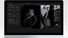 Artrya Salix AI-powered coronary plaque assessment software Artrya Salix AI-powered coronary plaque assessment software
