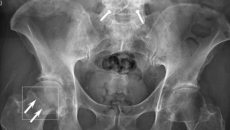 An image of the software detecting a fracture near a patient's hip An image of the software detecting a fracture near a patient's hip