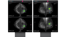 An analysis report generated by the Lunit INSIGHT DBT An analysis report generated by the Lunit INSIGHT DBT
