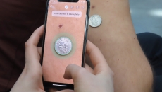 The Danish consumer platform helps users track skin changes. Miiskin, skin cancer