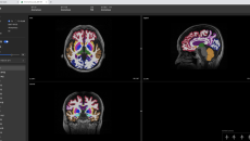 Neurophet's brain MRI scan analysis AI software shown on a desktop monitor Neurophet's brain MRI scan analysis AI software shown on a desktop monitor