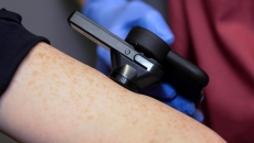 Also, study finds digital physiotherapy app is clinically effective. Moonhub, AI, Ascenti, ELARA, skin cancer, Wellola, NHS