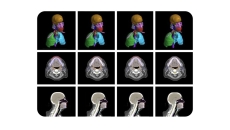An image from the radiotherapy planning model developed by Google and the Mayo Clinic. An image from the radiotherapy planning model developed by Google and the Mayo Clinic.