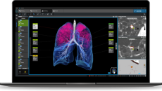 Interface of Coreline Soft's lung cancer imaging AI software Interface of Coreline Soft's lung cancer imaging AI software