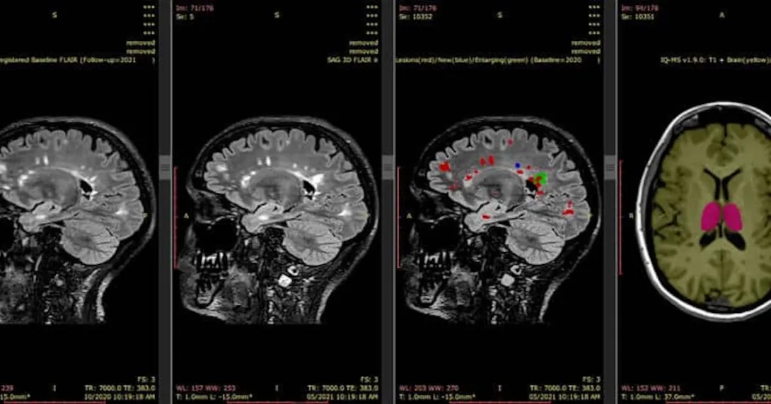 Automatic MRI scan analysis report generated by SNAC's AI-based platform iQ-solutions Automatic MRI scan analysis report generated by SNAC's AI-based platform iQ-solutions
