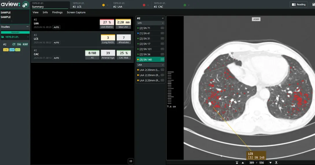 An interface of Coreline Soft's lung cancer screening analysis software An interface of Coreline Soft's lung cancer screening analysis software