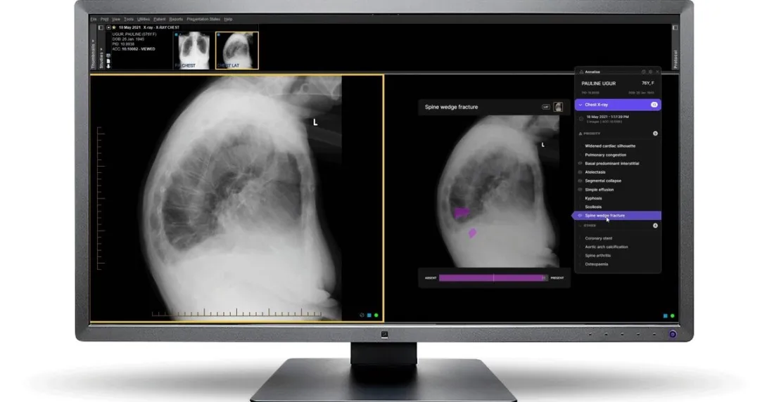 A desktop computer view of the Annalise CXR platform