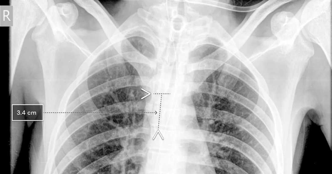 A chest x-ray showing Qure.ai's technology for breathing tube placement A chest x-ray showing Qure.ai's technology for breathing tube placement