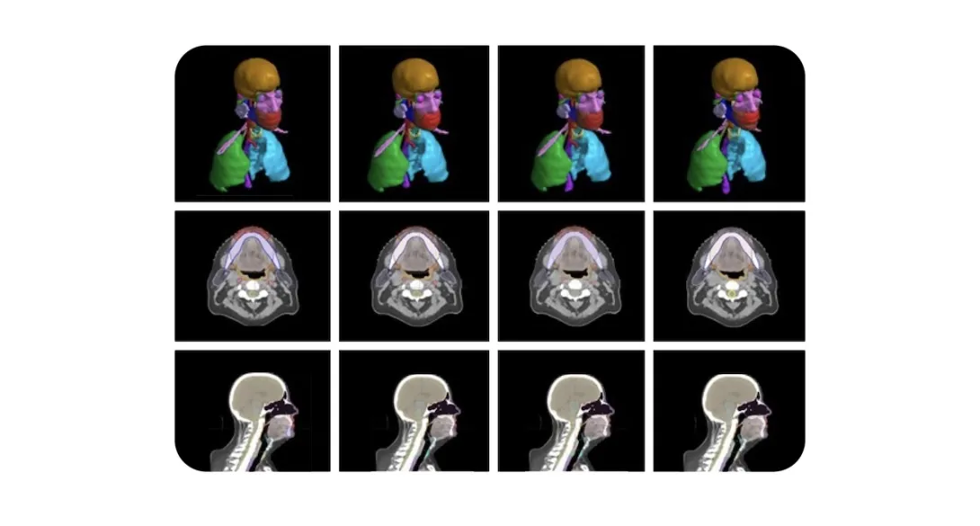 An image from the radiotherapy planning model developed by Google and the Mayo Clinic.